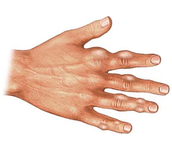 Відкладення кристалів сечової кислоти у м'яких тканинах пальців рук при подагричному артриті