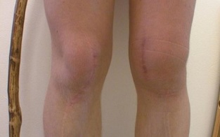 стадії розвитку колінного артрозу