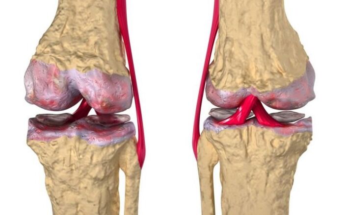 Артроз колінного суглоба