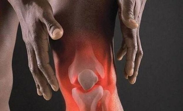 Артроз супроводжується запальним процесом у колінному суглобі